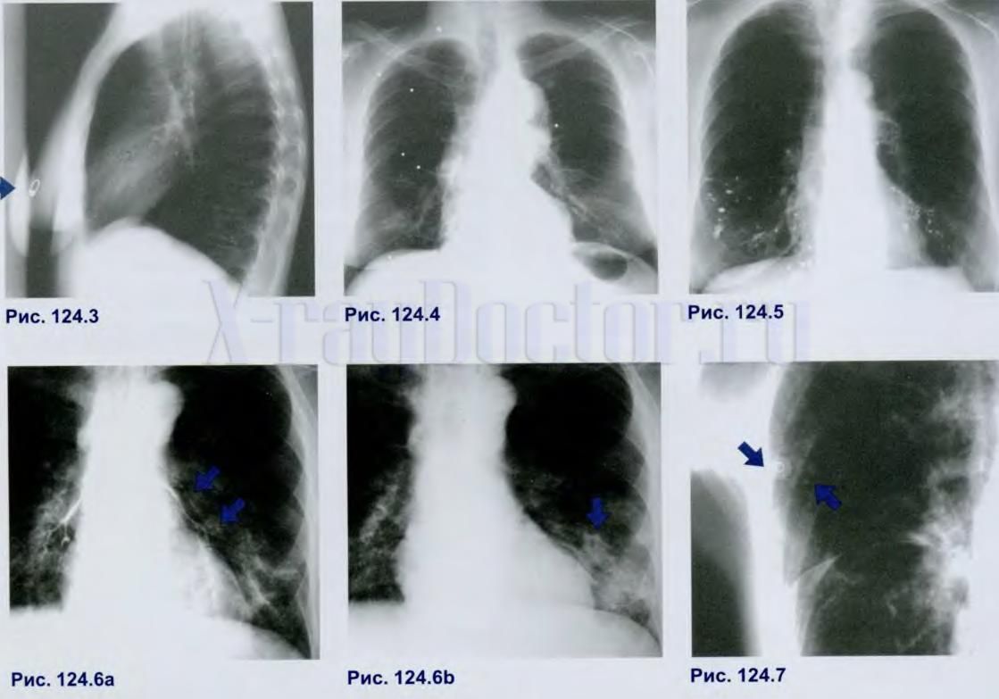белые пятна на рентгенограммах легких